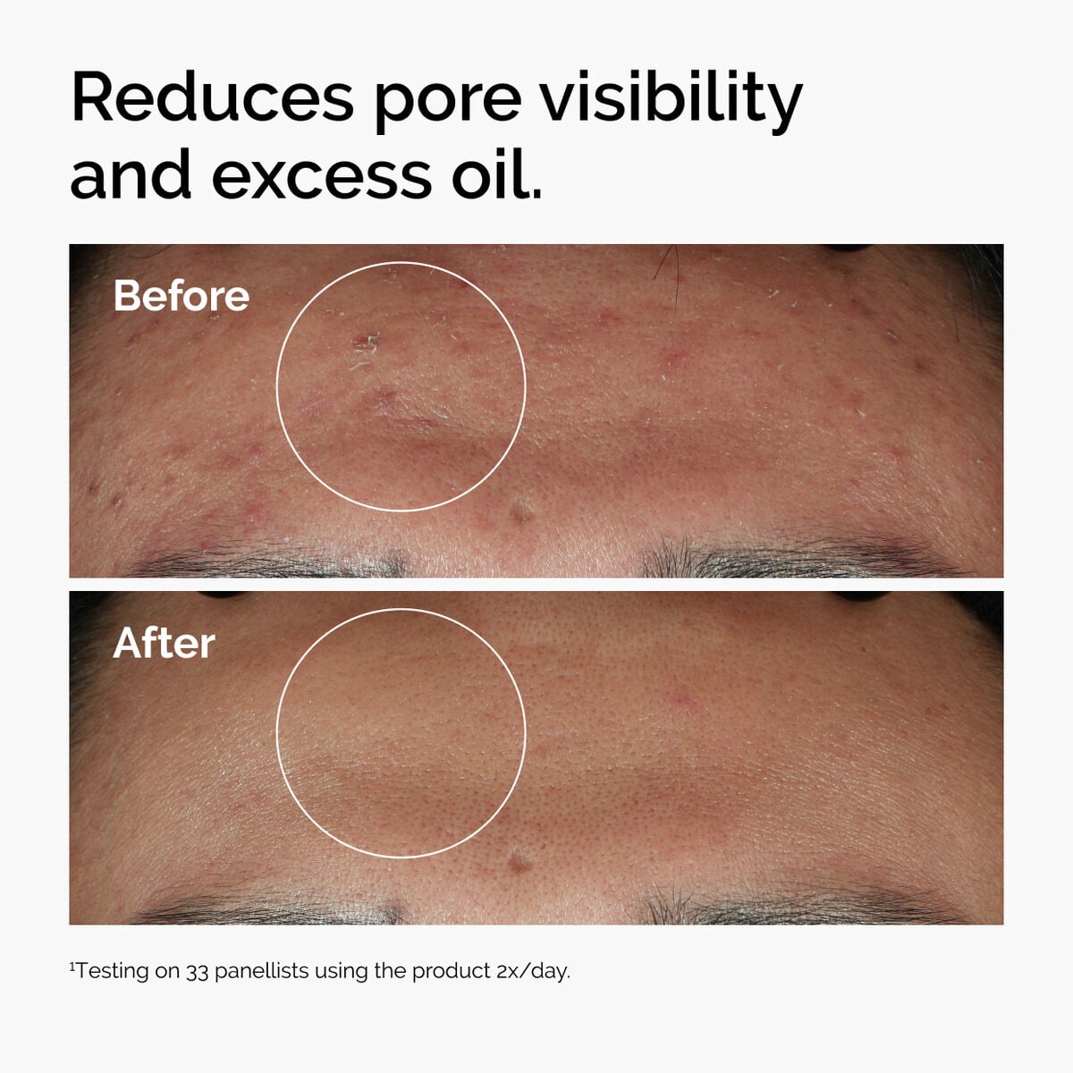 niacinamide-10-zinc-1-g6 ord-niacinamide-zinc-blemish-serum-before-after-pores.jpg
