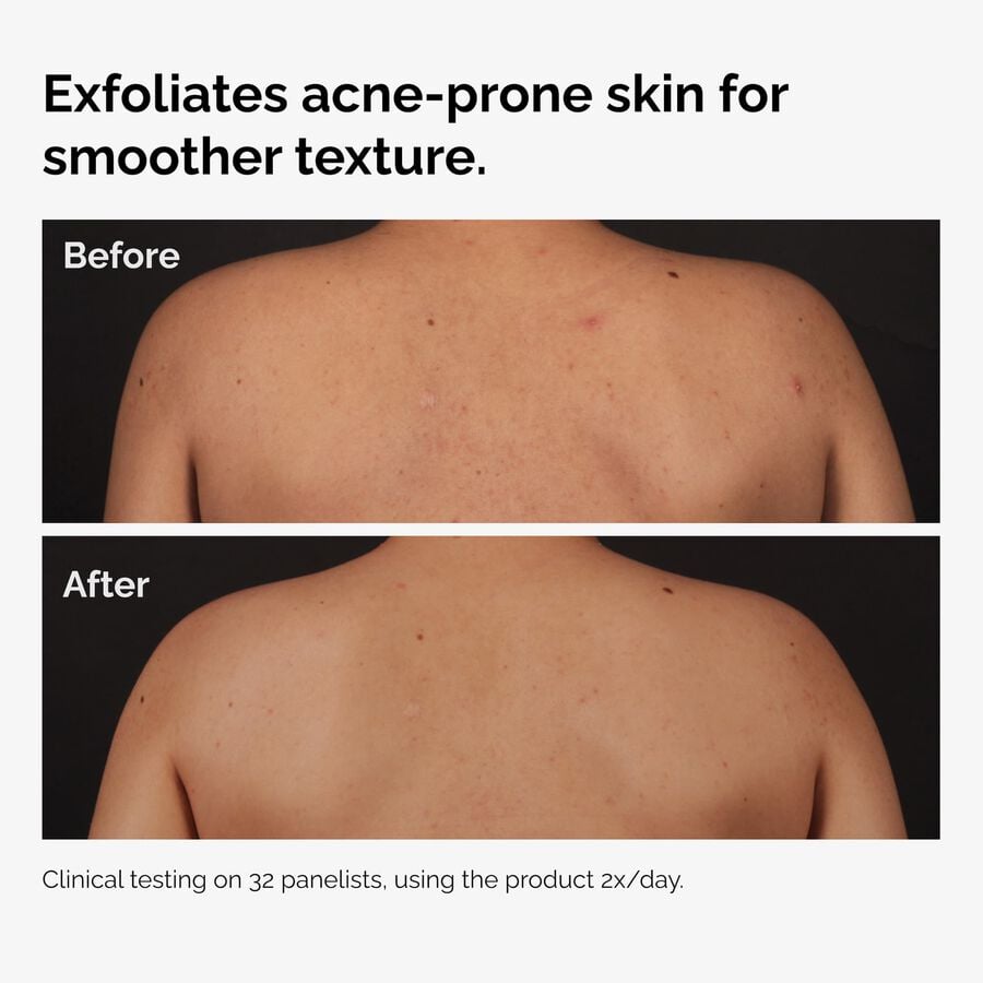 the-body-care-collection-o8 ord-salicylic-acid-body-serum-before-after-graphic-NA.jpg