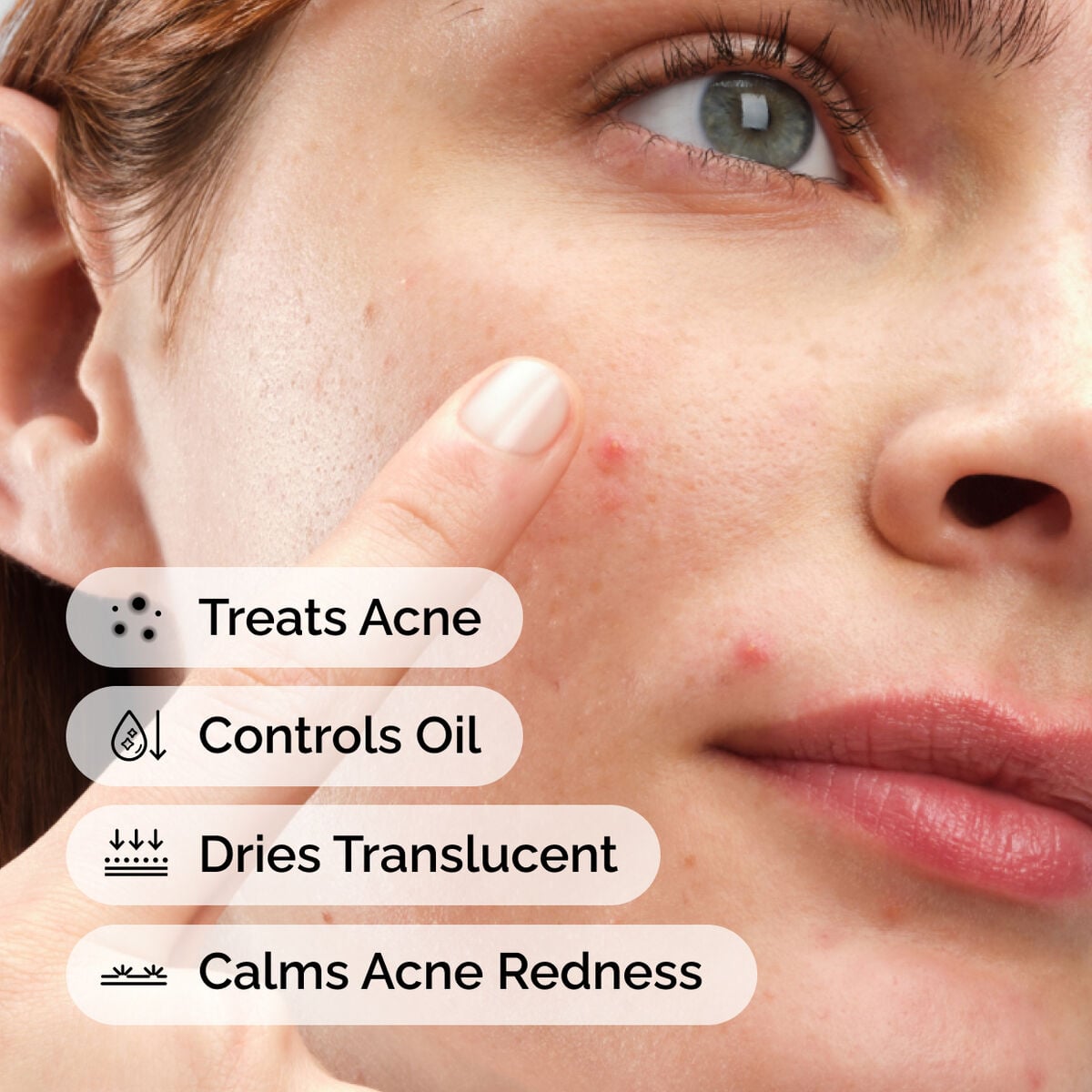 sulfur-10-powder-to-cream-concentrate-e5 ord-sulfur-10pct-powder-to-cream-concentrate-model-application-with-benefits-acne.jpg