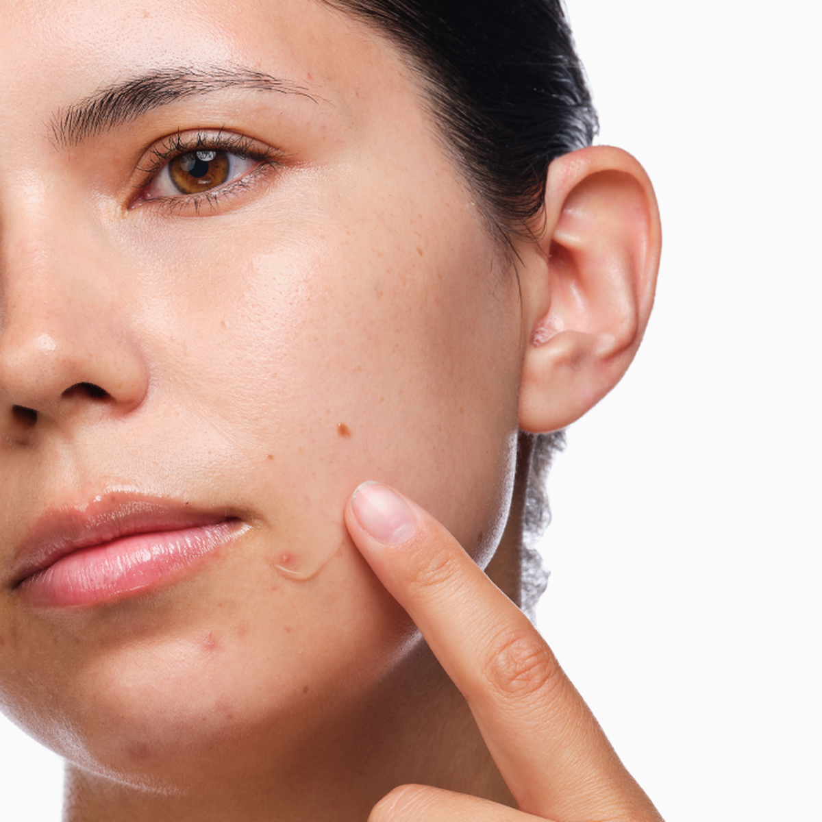 the-acne-set-g0 rdn-the-acne-set-application.png